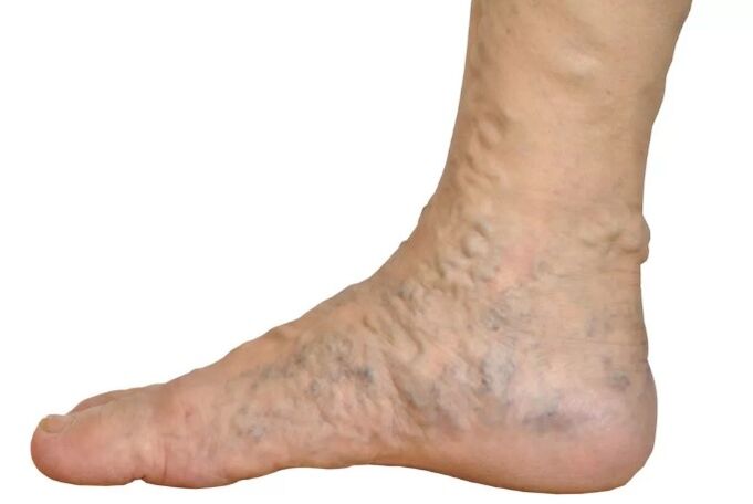 Le malattie di Veen sulle gambe