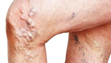 Le principali manifestazioni delle vene varicose sulle gambe