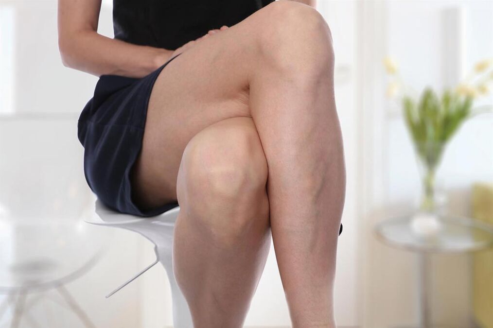 Vene varicose in una donna