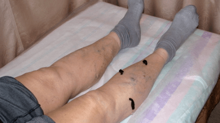 trattamento delle vene varicose con le sanguisughe
