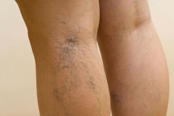 vene varicose nelle gambe delle donne