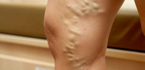 vene varicose sulle gambe delle donne