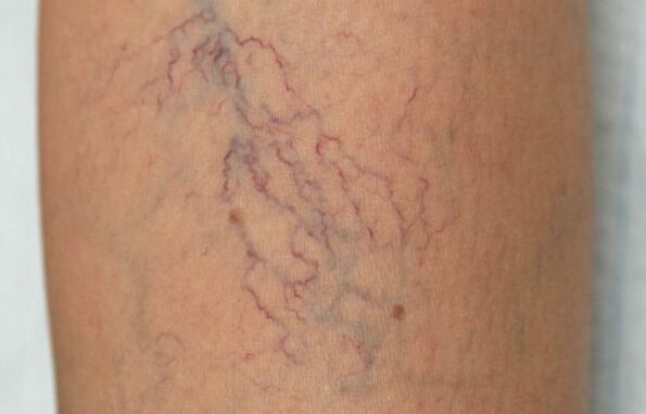 vene varicose sulle gambe nelle donne
