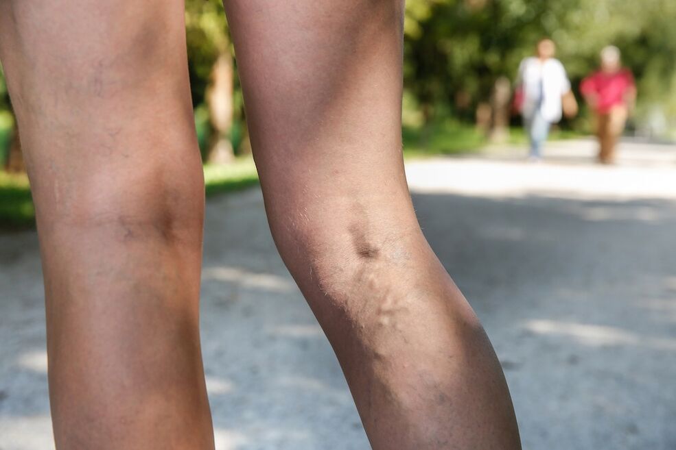vene varicose sulle gambe