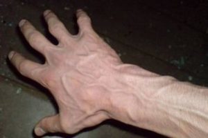 metodi di trattamento delle vene varicose nelle mani