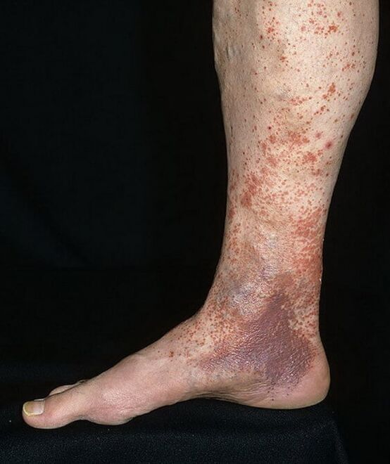 Dermatite varicosa