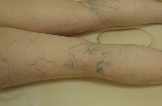 Stelle varicose sulle gambe