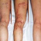 Vene varicose delle gambe