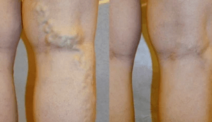 segni e sintomi delle vene varicose sulle gambe negli uomini