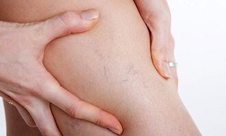 ragioni per lo sviluppo delle vene varicose nelle gambe