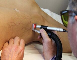 controindicazioni per il trattamento delle vene varicose con un laser