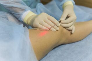 trattamento laser delle vene varicose l'essenza della procedura