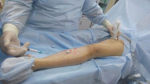 intervento chirurgico per le vene varicose alle gambe