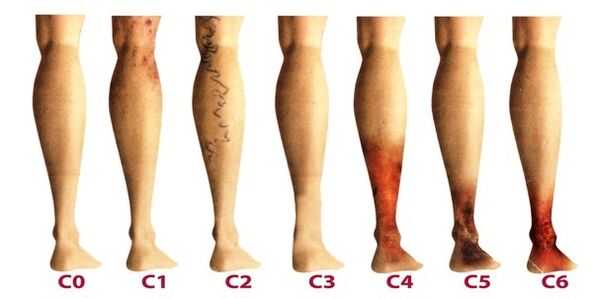 fasi di sviluppo delle vene varicose sulle gambe