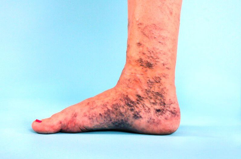 vene varicose trascurate sulla gamba