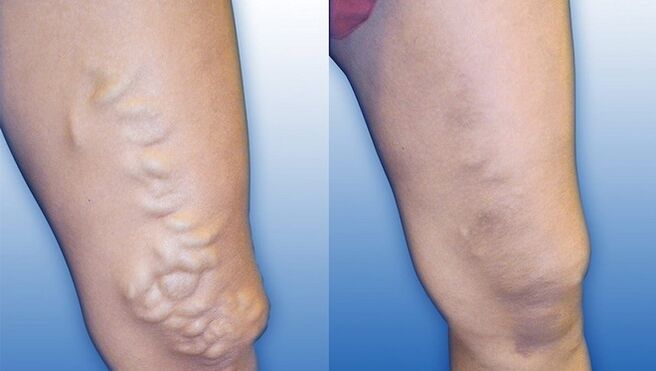 Gambe prima e dopo il trattamento delle vene varicose gravi