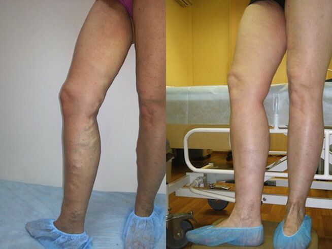 Gambe prima e dopo il trattamento laser delle vene varicose