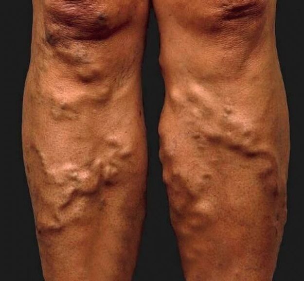 vene varicose trascurate sulle gambe