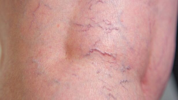 Segni di vene varicose reticolari degli arti inferiori - dilatazione delle vene sottili e maglia vascolare