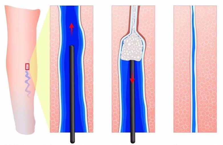 scleroterapia per le vene varicose alle gambe negli uomini